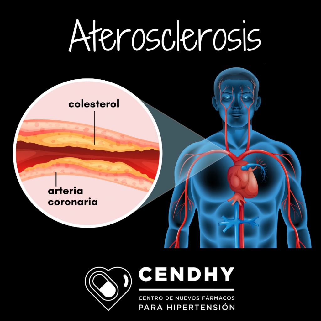 Aterosclerosis, colesterol, arteria coronaria. CENDHY. Alimentos, corazón, cardiovascular.